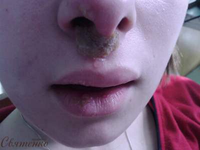 Может ли возникать герпес в носу и какие препараты использовать?
