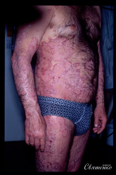 Фотография мужчины больного псориазом.