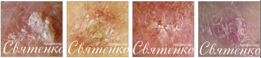 4 формы солнечного кератоза изображенного на рисунке.