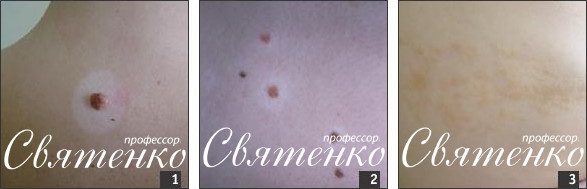 Амеланотическая меланома: она не похожа на другие меланомы