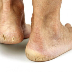 Трещины на стопах ног лечение