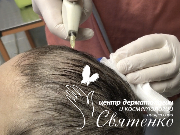 Карбокситерапия волосистой части головы в Днепре